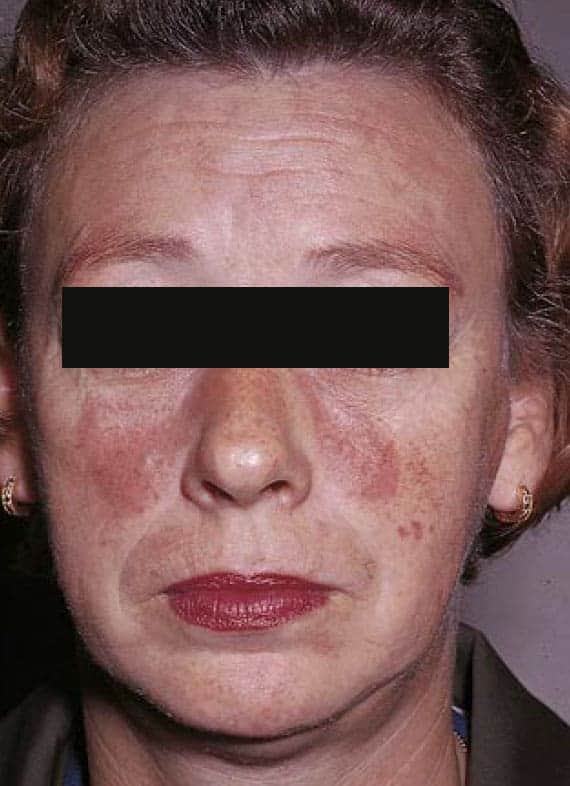 Lupus Butterfly Rash On Face