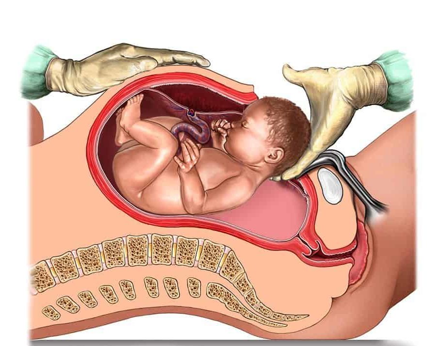 Medical illustration Childbirth