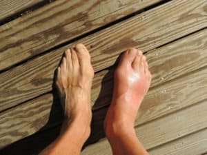 Read more about the article What is gout? Symptoms, treatment, and complications.
