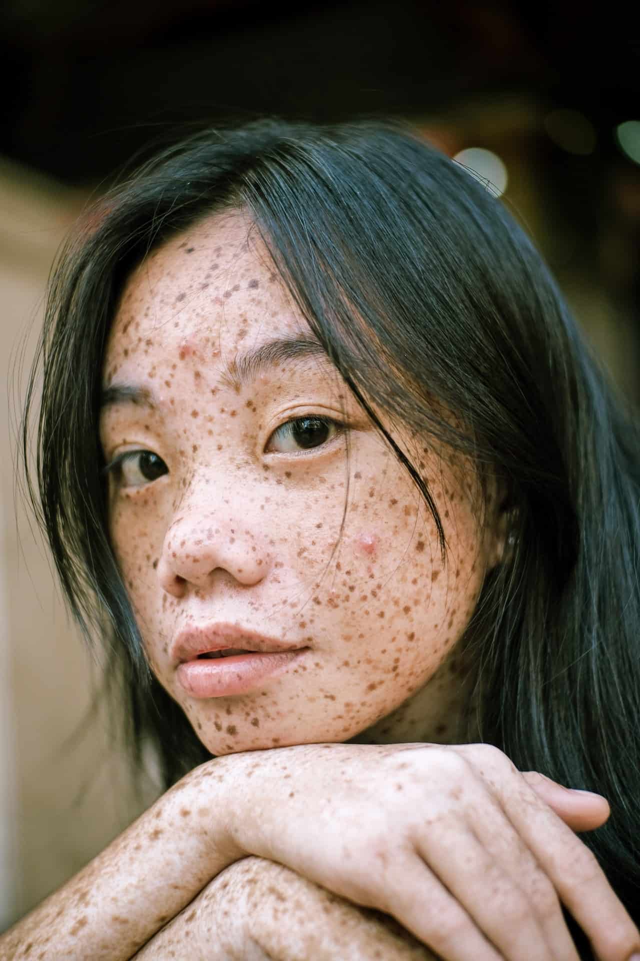 Teenage acne