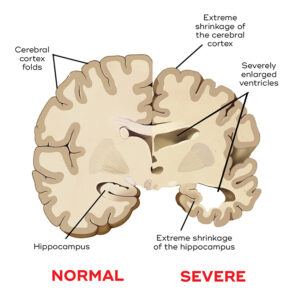 Read more about the article What is Alzheimer’s Disease? Symptoms & Causes