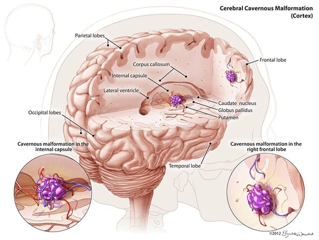 CCM disease