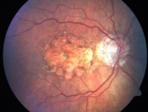 Read more about the article Age-related Macular Degeneration – symptoms, causes, treatment
