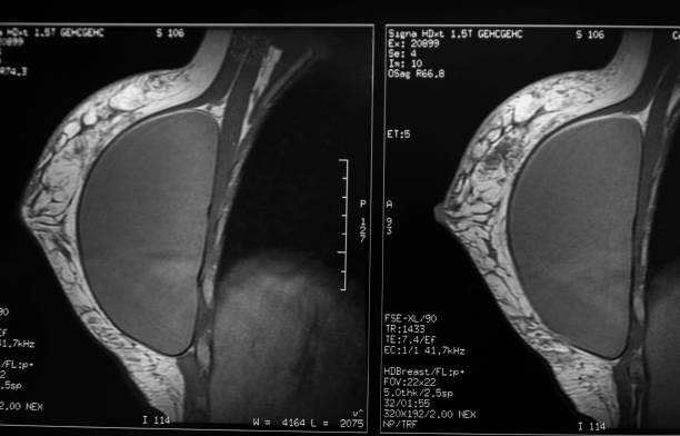 Breast implant CT - after breast augmentation surgery