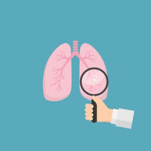 Read more about the article What is mesothelioma? Can you get compensation?