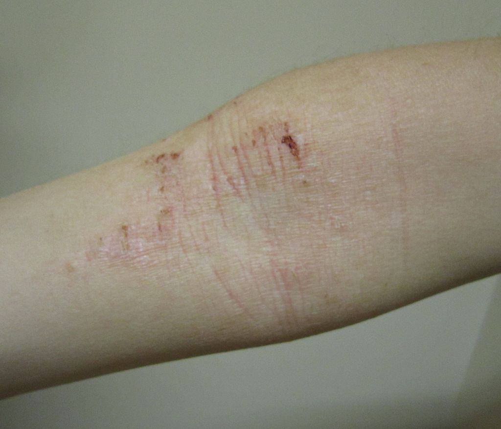 Atopic Eczema (Dermatitis) in flexural surface