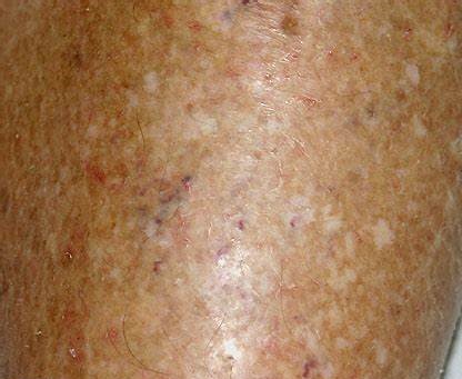 All About Eczema (Dermatitis) - Symptoms, Diagnosis, Treatment - Costamedic