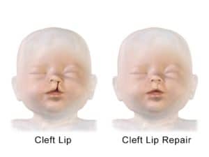 Read more about the article Cleft Lip and Palate – causes, symptoms, treatment, prognosis