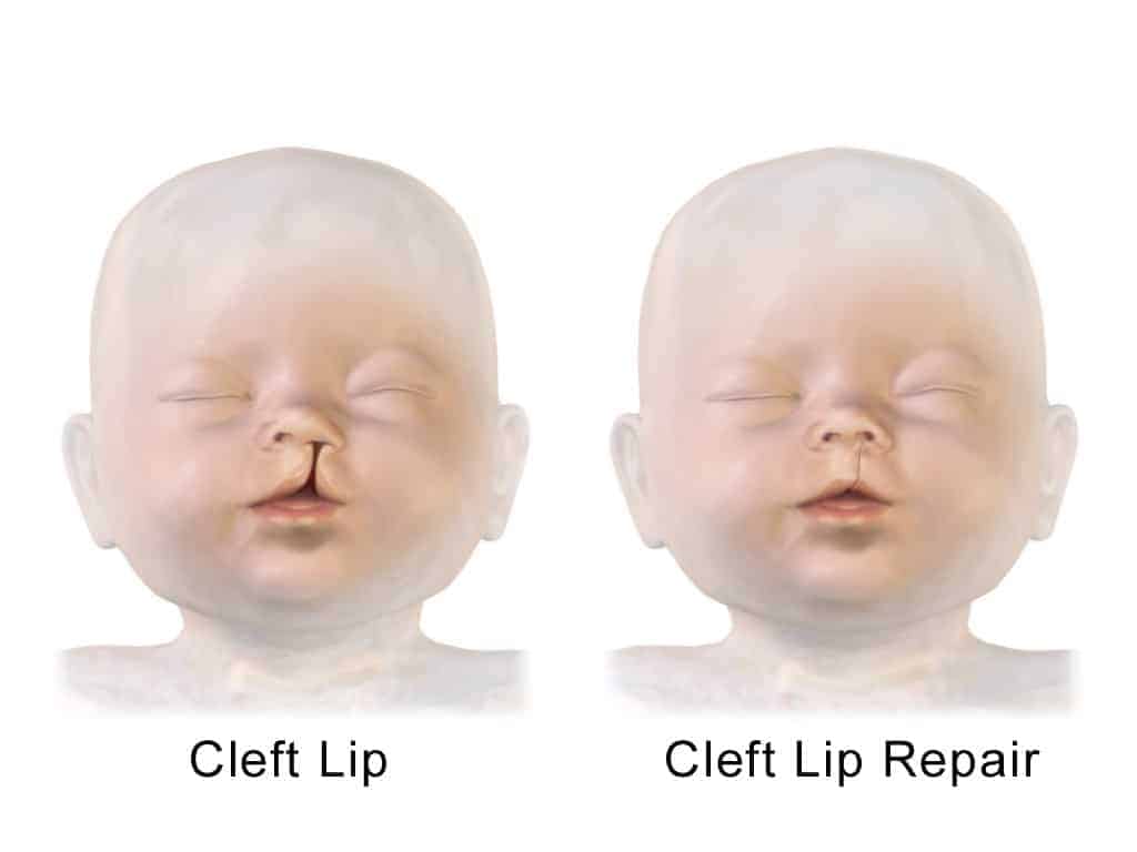 cleft lip and palate surgery repair