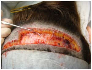 Read more about the article Hair transplantation – cost and outcome | Costamedic