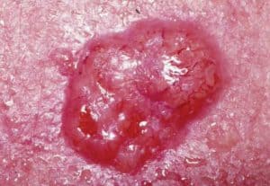 Basal Cell Carcinoma Vs Squamous Cell Carcinoma (BCC Vs SCC) - Costamedic