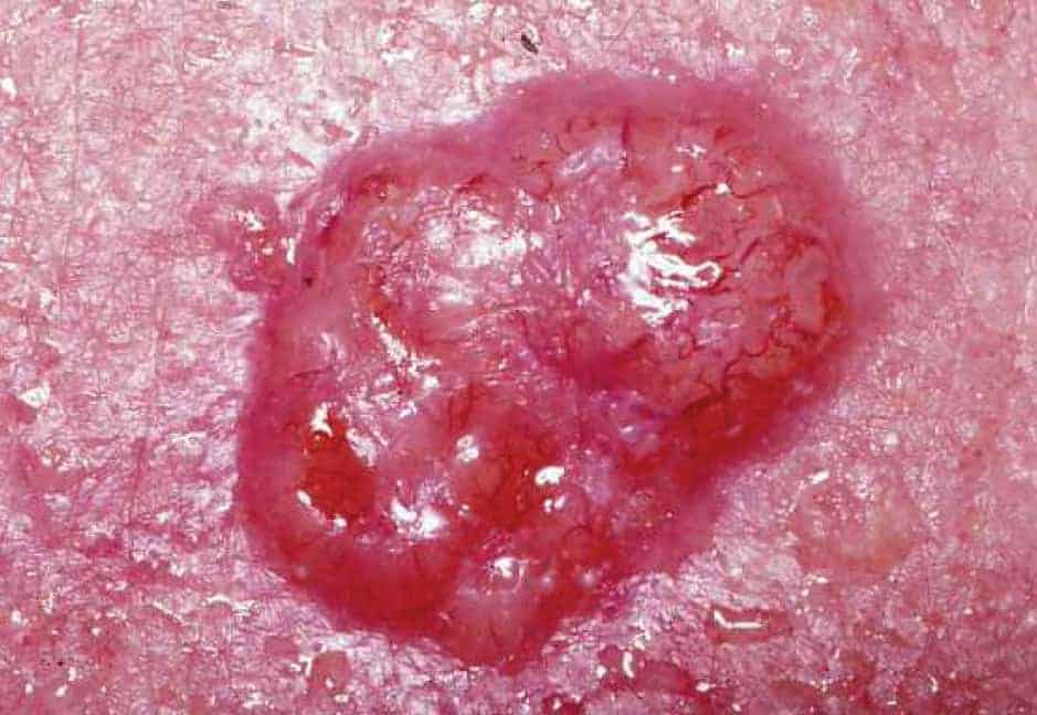 Basal cell carcinoma (BCC vs SCC)