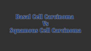 Read more about the article Basal Cell Carcinoma Vs Squamous Cell Carcinoma (BCC Vs SCC)