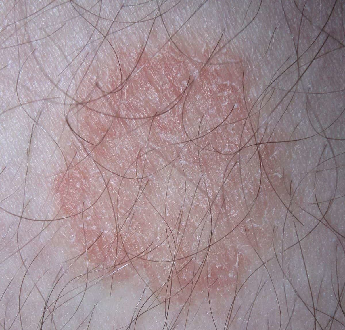 Fungal Skin Cancer