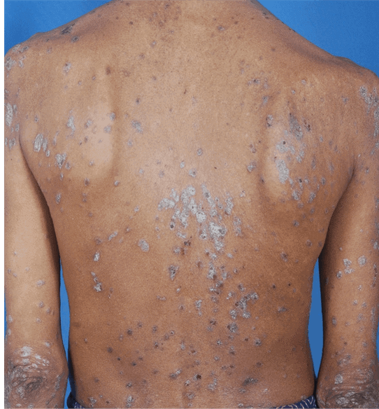 Guttate Psoriasis