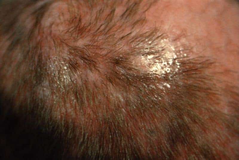 Fungal skin infection - Tinea capitis