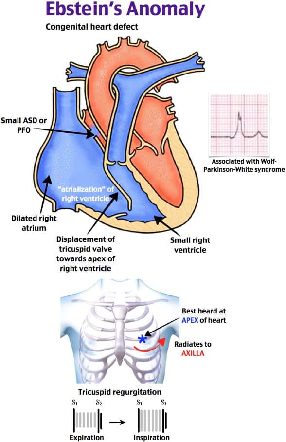 Ebstein anomaly features