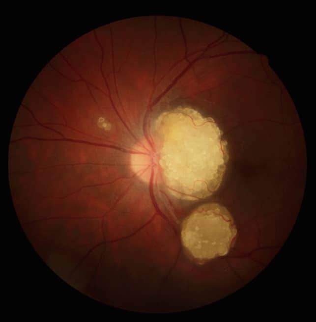 Neurofibromatosis Type 1 And Type 2 Features Diagnosis And Treatment