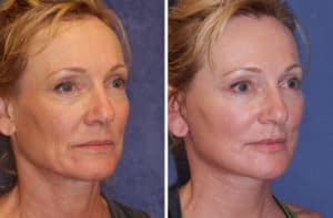 Read more about the article Facelift surgery – procedure, recovery, cost, expected outcome