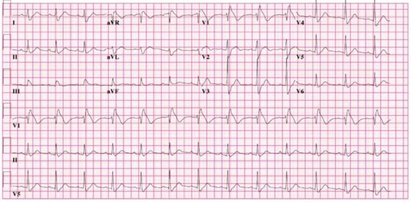 Brugada syndrome - Costamedic