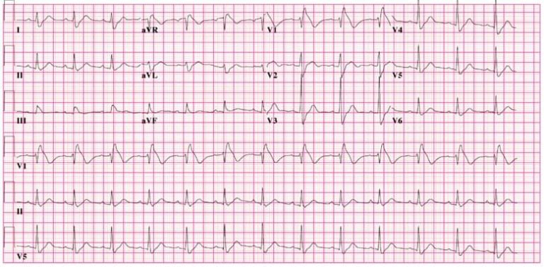 Brugada syndrome - Costamedic