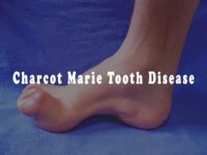 Read more about the article Charcot Marie Tooth disease