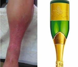 charcot marie tooth disease -Inverted champagne bottle deformity
