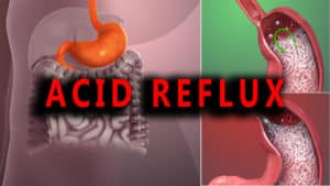 Read more about the article Gastroesophageal Reflux Disease (GERD) – Causes, Symptoms, Diagnosis, and Treatment