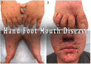 Read more about the article Hand Foot and Mouth Disease
