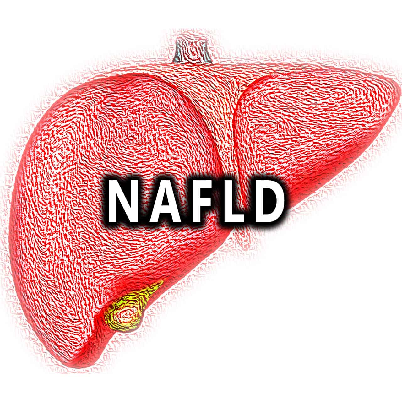 NAFLD