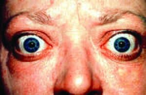 Read more about the article Thyroid Eye Disease