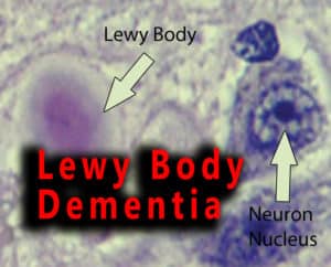 Read more about the article Lewy Body Dementia