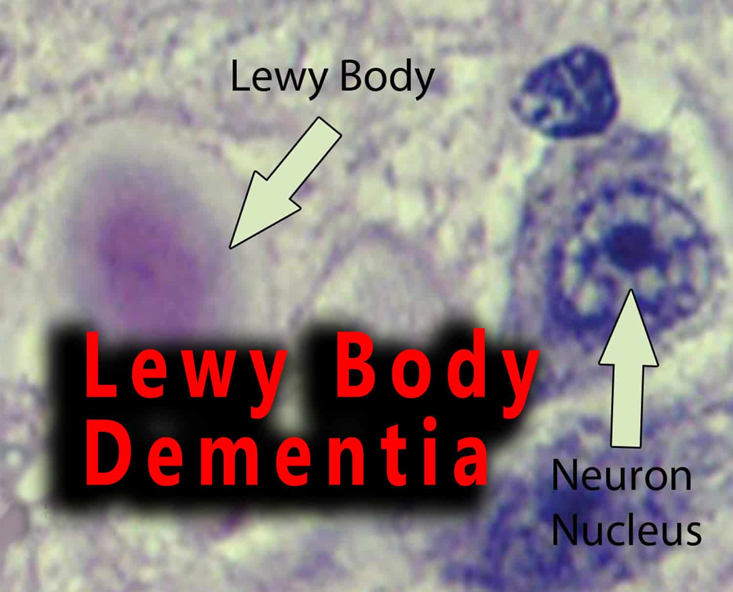 Lewy Body Dementia - Costamedic