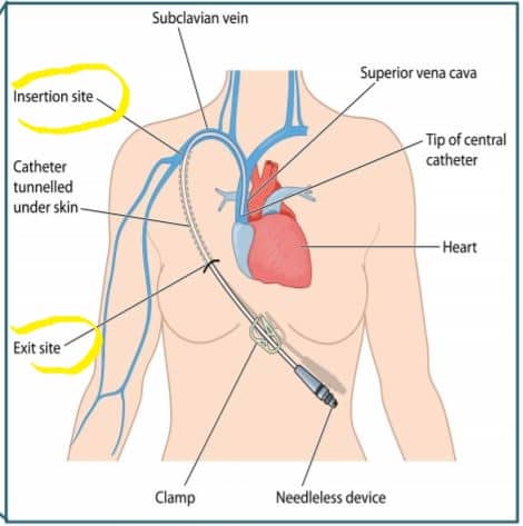 CLABSI - Central line associated bloodstream infection