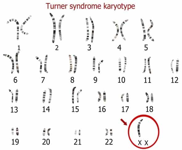 Turner syndrome karyotype