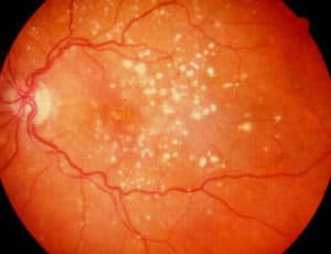 Read more about the article Dry and Wet Age-Related Macular Degeneration