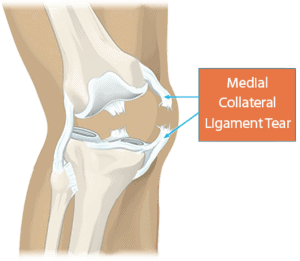 Read more about the article What is Medial Collateral Ligament (MCL) injury