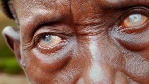 Read more about the article River Blindness
