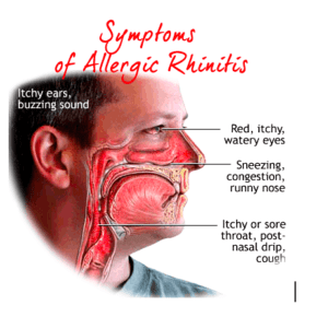 best cold medicine for allergic rhinitis