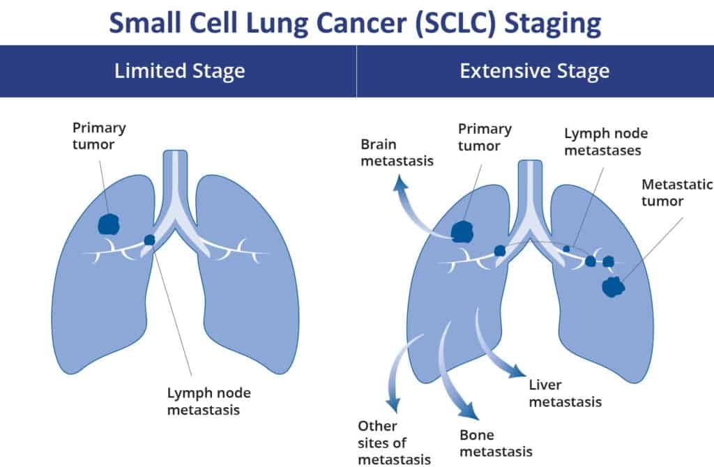 small cell lung carcinoma stages