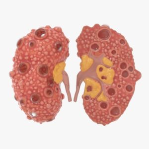 Adult polycystic kidney disease