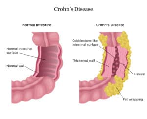 Read more about the article Crohn’s disease – Symptoms, Flair up, Diagnosis and Treatment