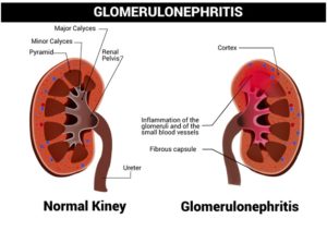 Read more about the article Glomerulonephritis – Symptoms, Causes, Types, Diagnosis & Treatment