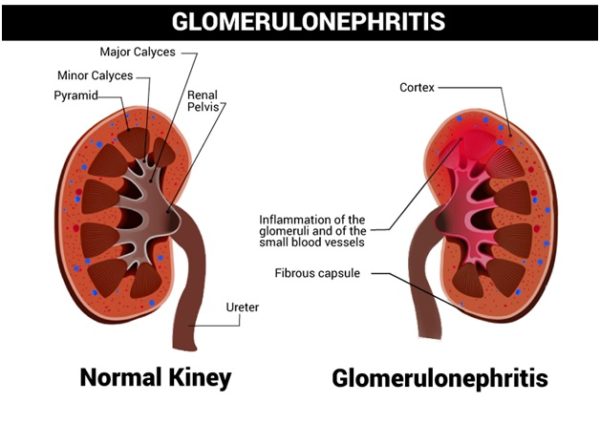 Glomerulonephritis Symptoms Causes Types Diagnosis And Treatment Costamedic 4575