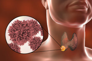 Read more about the article Medullary Thyroid Carcinoma