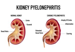 Read more about the article Pyelonephritis – Symptoms, Causes & Treatment