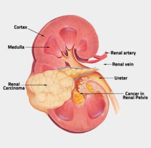 Read more about the article Renal Cell Carcinoma – Symptoms, and Treatment