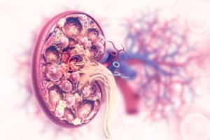 Read more about the article SLE Nephritis