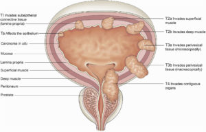 Read more about the article TCC Bladder (Transitional Cell Carcinoma) – Symptoms and Treatment