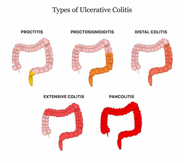 Ulcerative colitis types